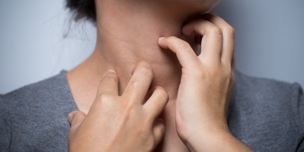 Living with Eczema - The Story of Felicia